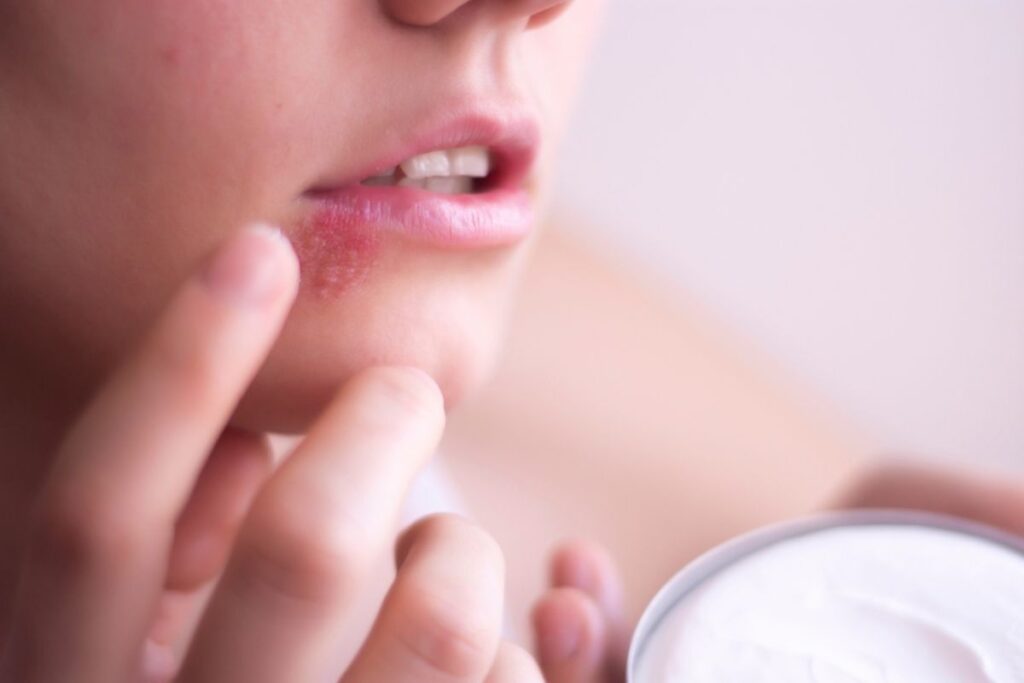Curar el herpes labial con propóleo