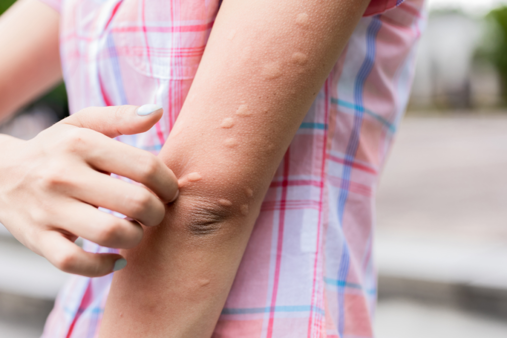 Picadura de araña ¿Es peligrosa? Aspecto, síntomas y cómo se trata